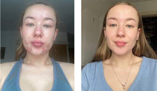 model with acne showing using accumax results