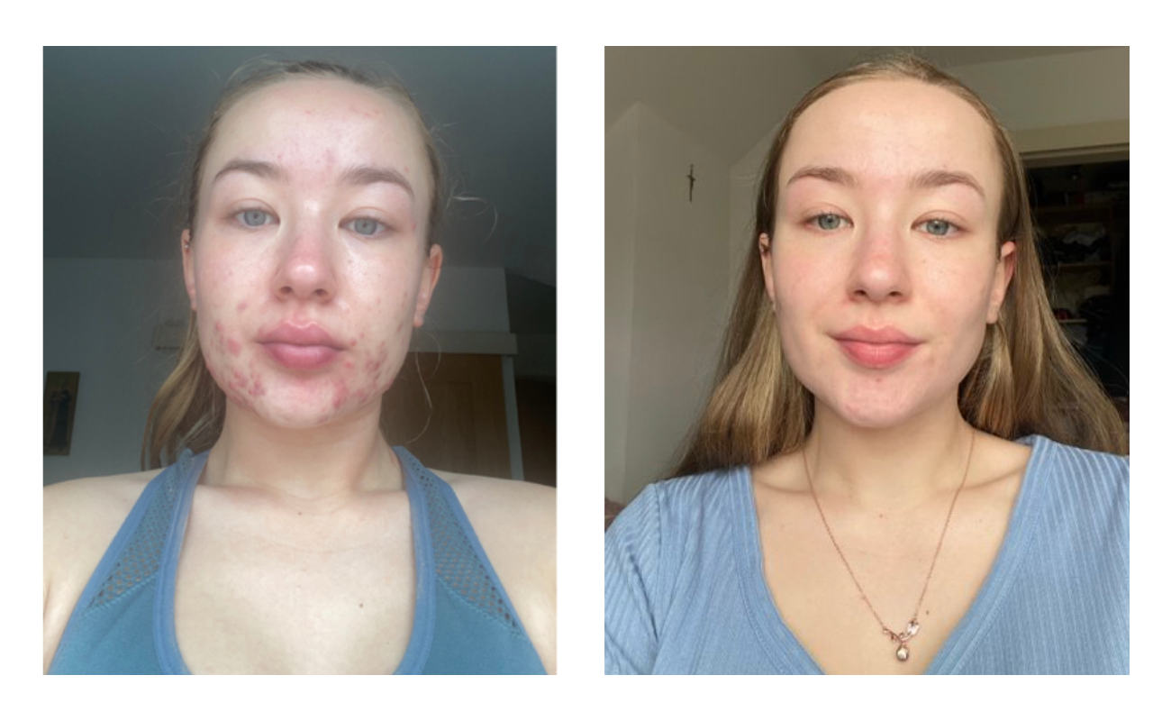 Before and after comparison of a person with acne on their face.