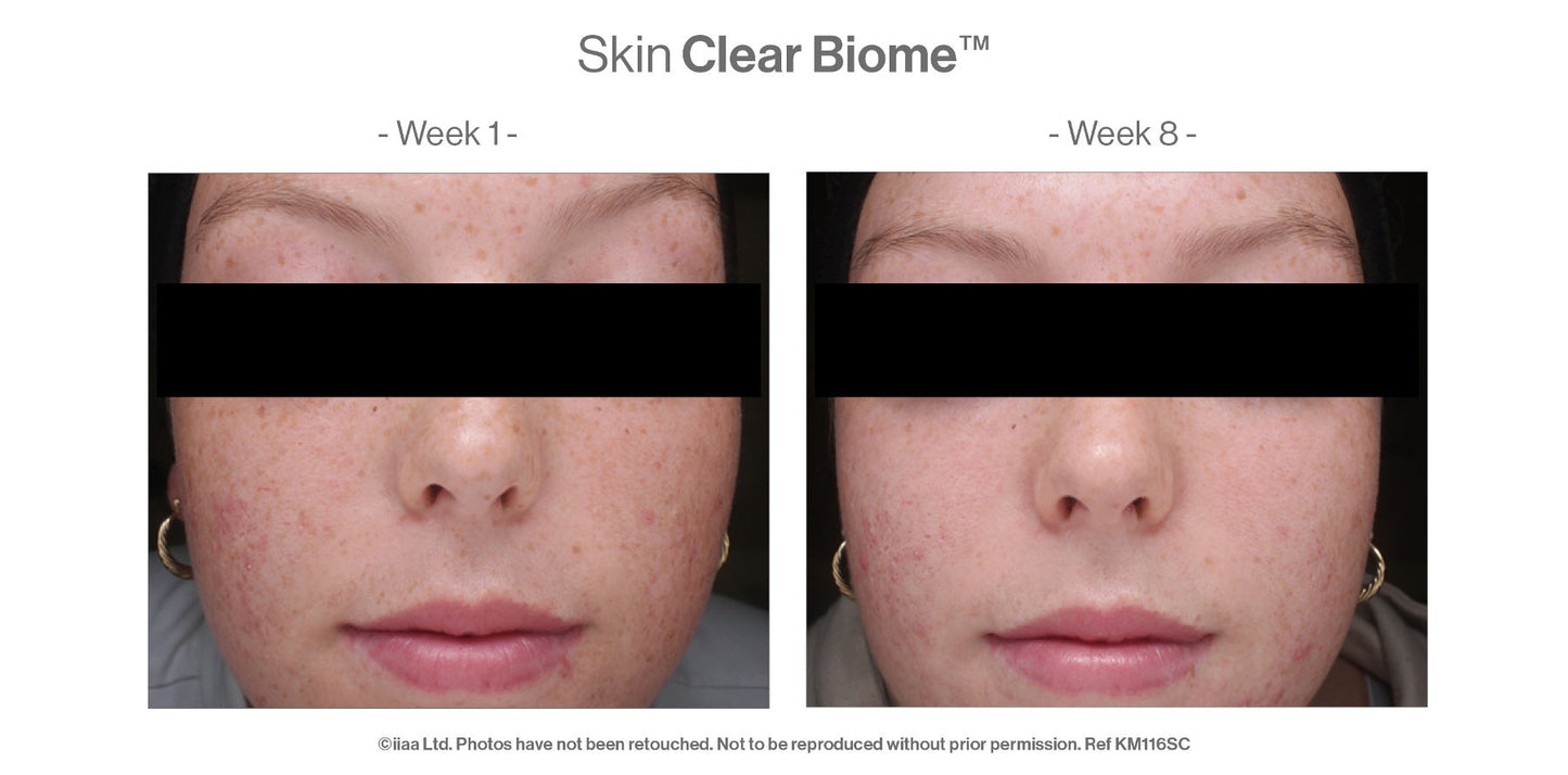 Before and after comparison of Skin Clear Biome treatment on a person's face.