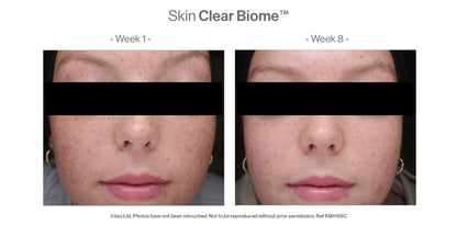 Before and after comparison of Skin Clear Biome treatment on a person's face.