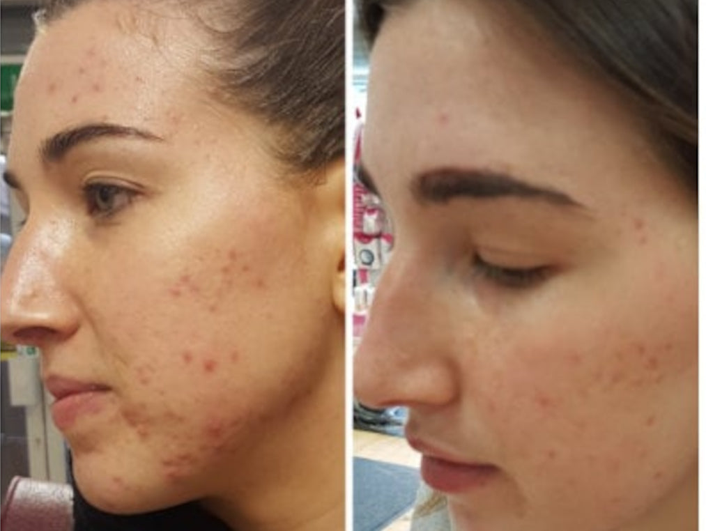 Clear Skin Transformation Programme