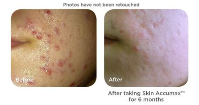 acne skin solution skin accumx