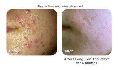skin accumax before after